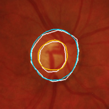 PAPILA RET004OD, glaucoma