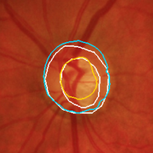 PAPILA RET004OS, glaucoma